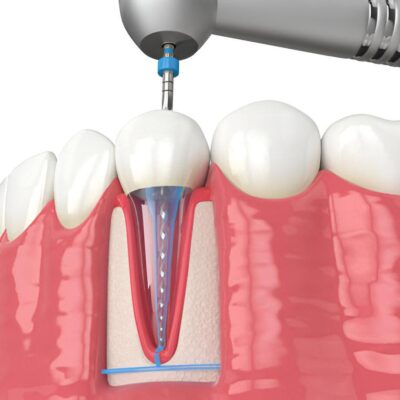 Endodontics