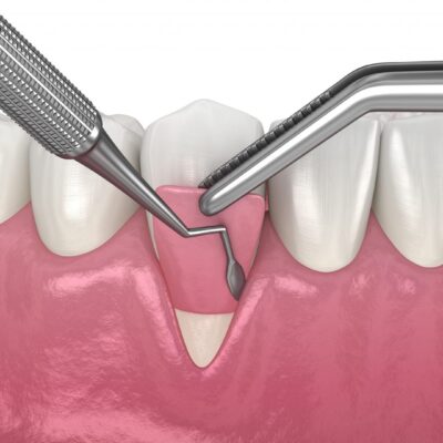 Periodontics